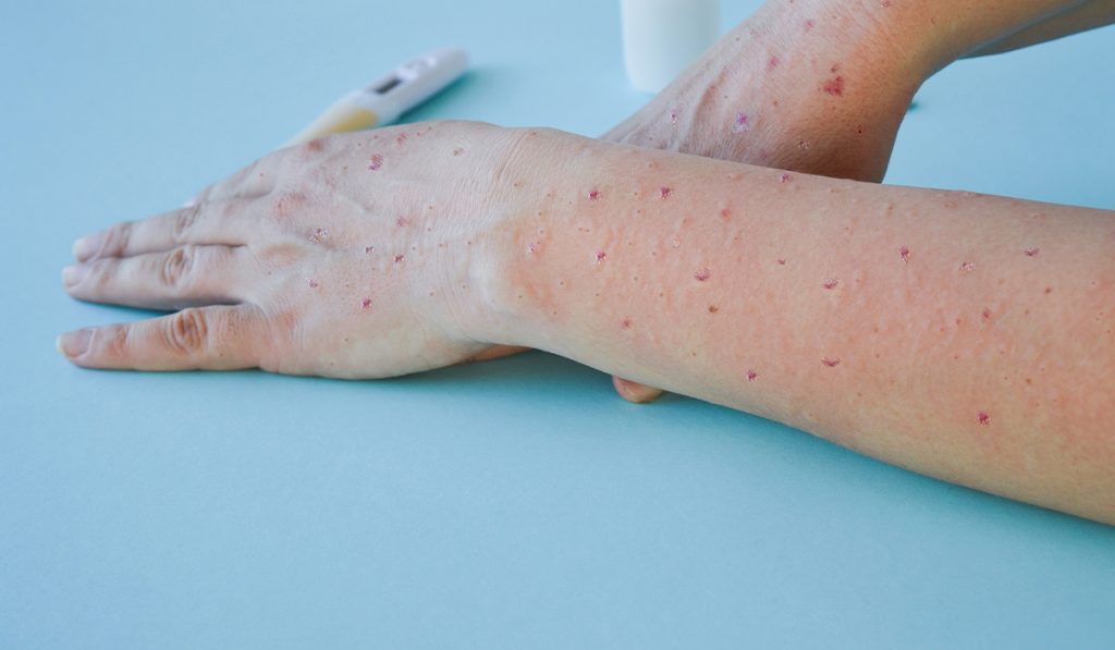 Viruela del mono y hepatitis en Colombia: información para evitarlas
