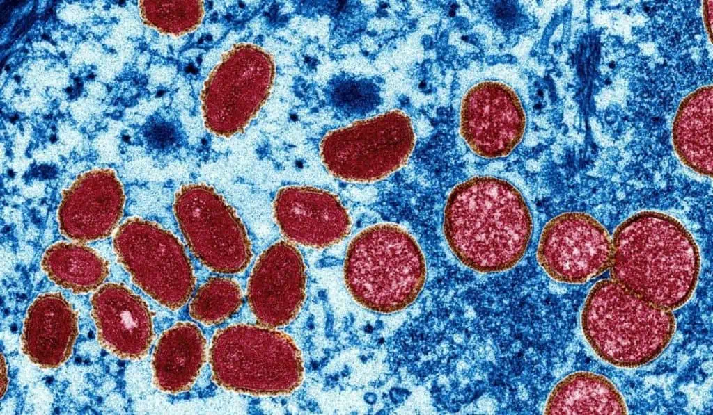 Viruela del mono: ¿Cómo se transmite y cuáles son sus síntomas? Viruela del mono